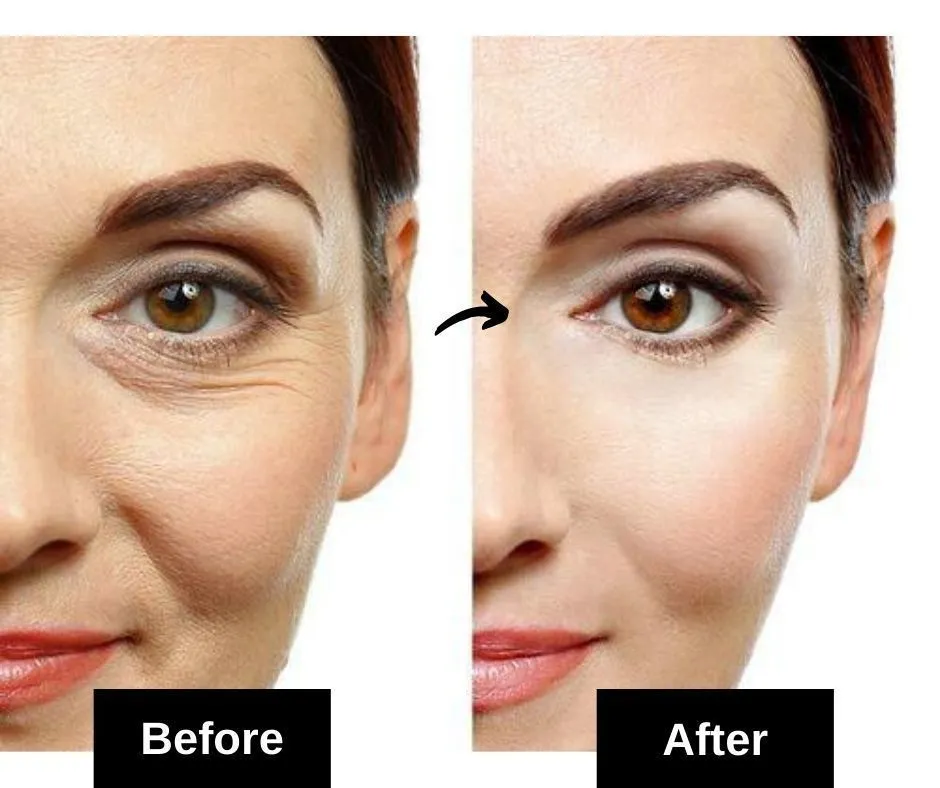 How to remove under eye wrinkle at home tips ?